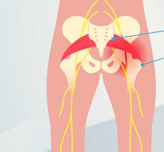 坐骨神經痛中藥