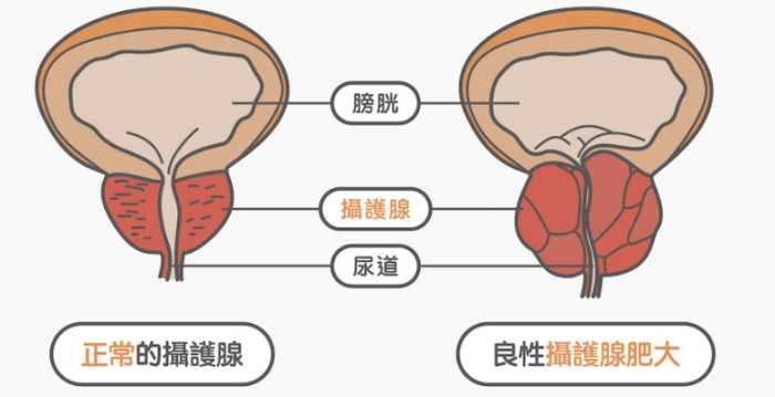 攝護腺腫大中藥