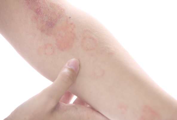 異位性皮膚炎中藥