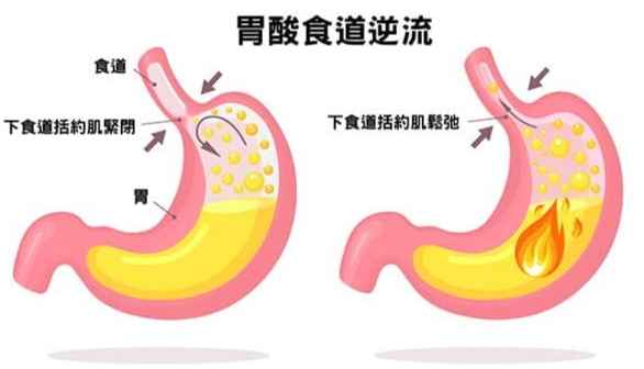 中藥胃食道逆流