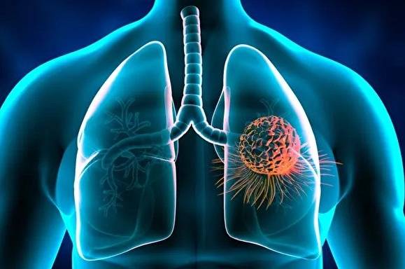 肺癌中藥治療全攻略：自然療法輔助選擇與實用指南