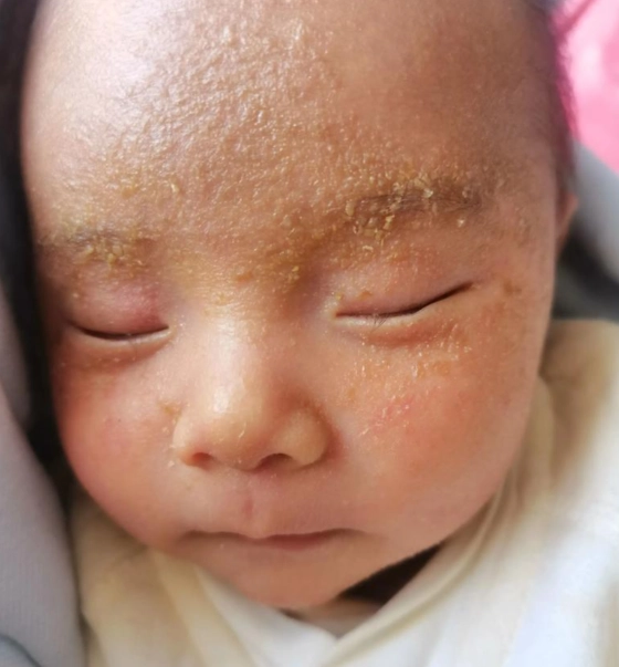 嬰兒脂漏性皮膚炎治療