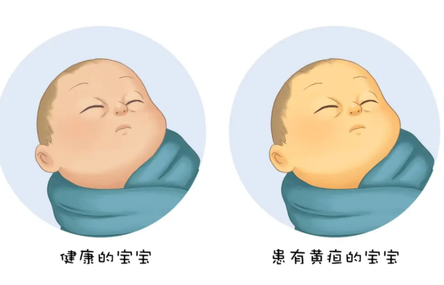 嬰兒黃疸症狀