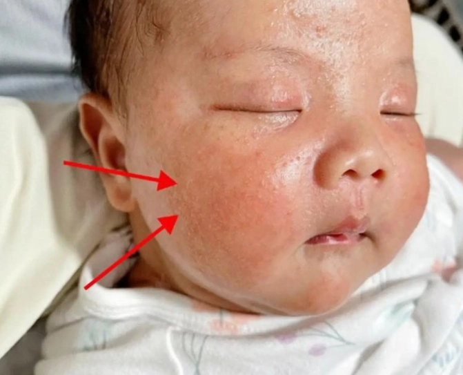 新生兒胎毒症狀