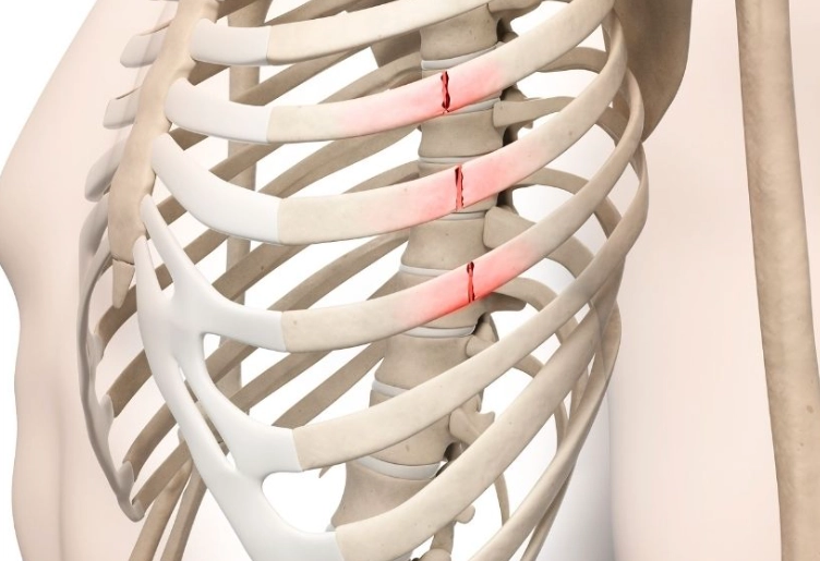 肋骨斷裂恢復時間