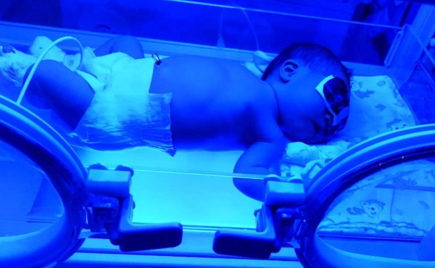 新生兒黃疸照光時間