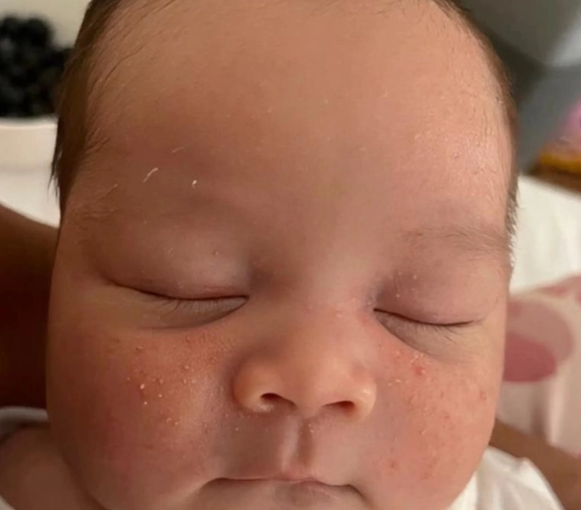 新生兒臉上顆粒 新生兒臉上顆粒