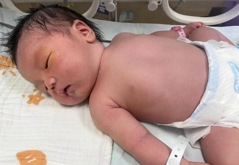 新生兒黃疸指數