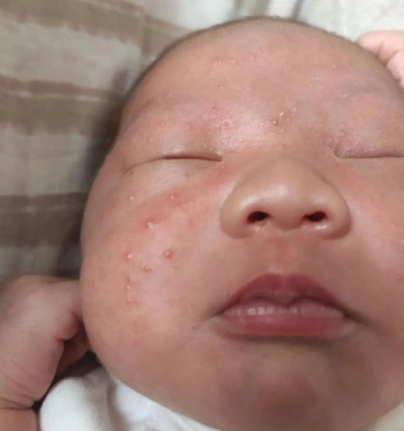 嬰兒痤瘡治療