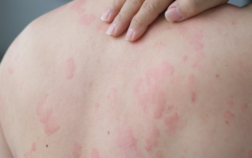 蕁麻疹治療時間