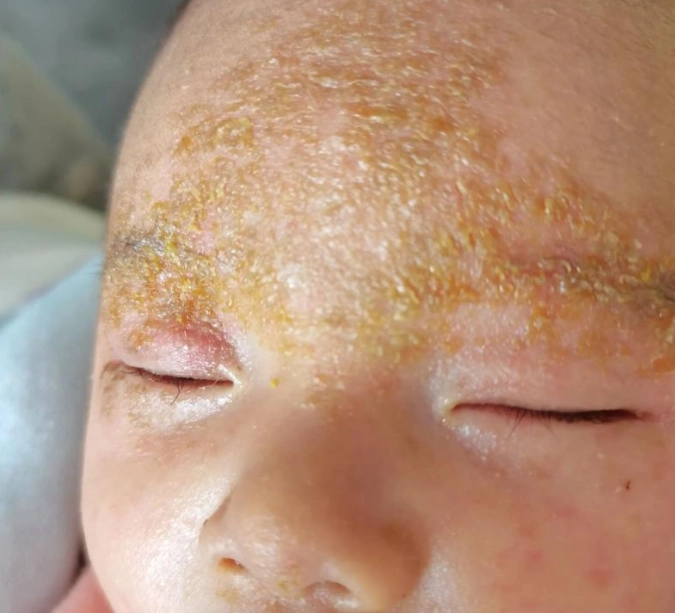 凡士林脂漏性皮膚炎