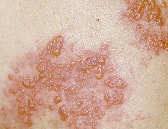 带状疱疹康复时间