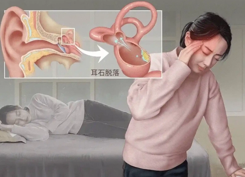 耳石症恢復時間