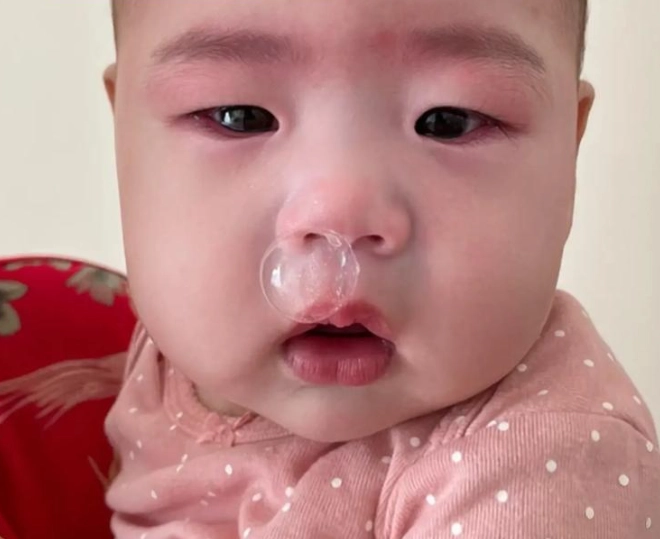 嬰兒流鼻水看醫生