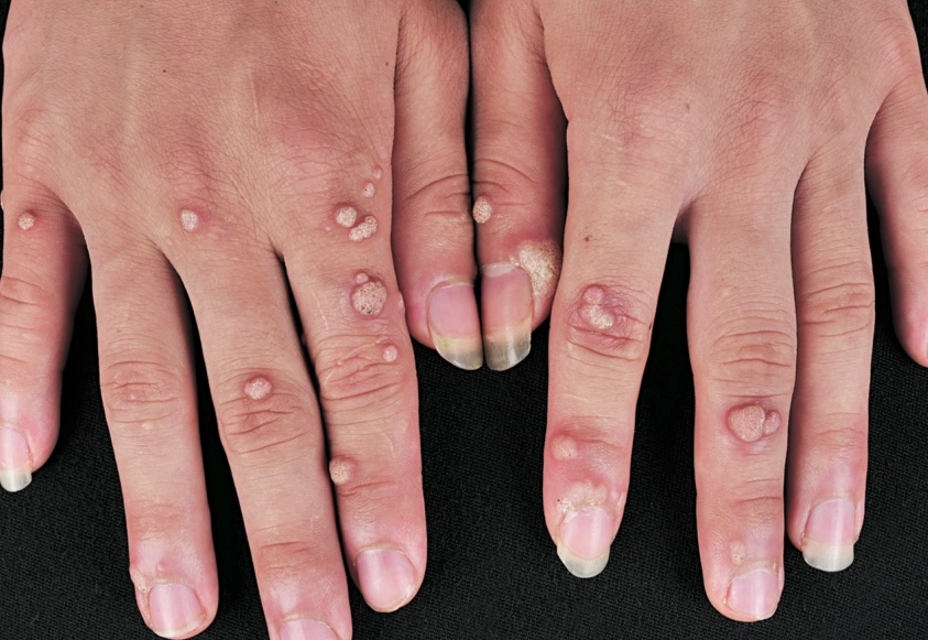 病毒疣根除方法