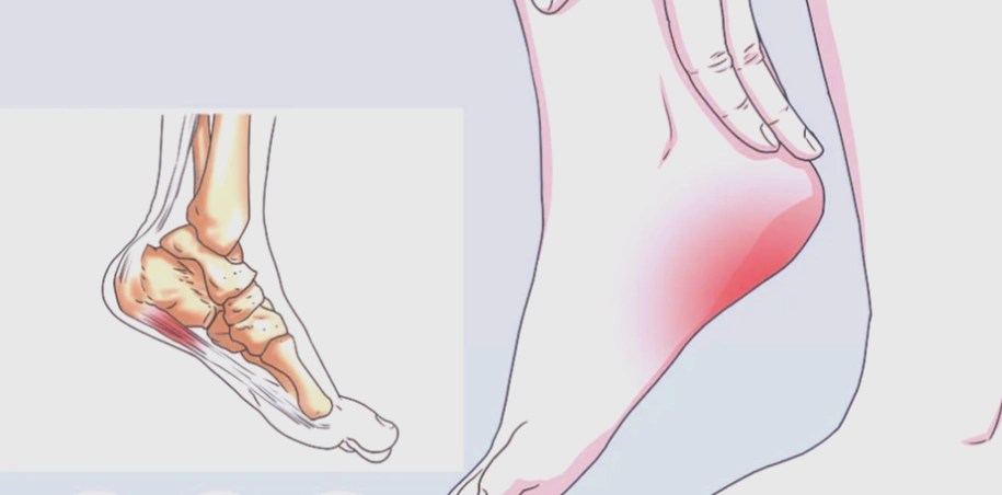 足底筋膜炎症狀