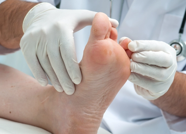 香港腳治療時間