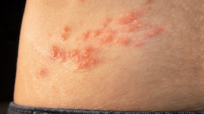 生殖皰疹多久會好