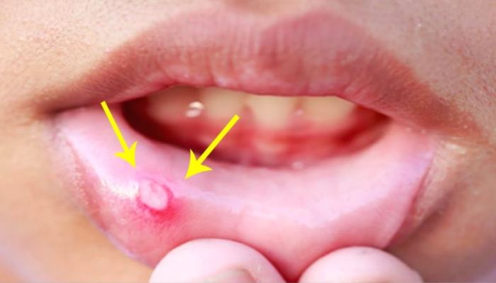 念珠菌感染多久會好