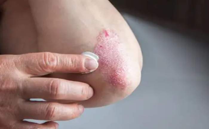 銀屑病中醫治療