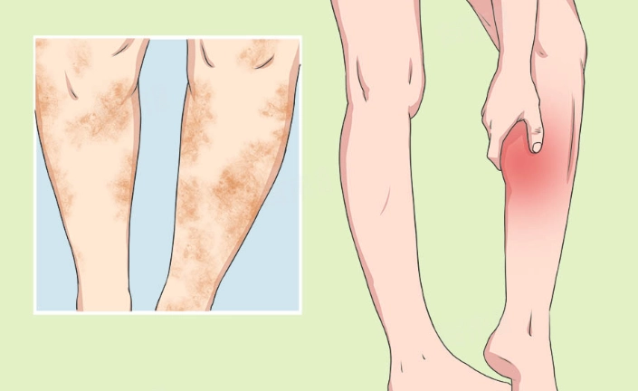 大腿筋膜發炎多久會好