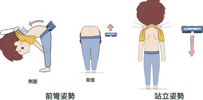 脊椎側彎會好嗎