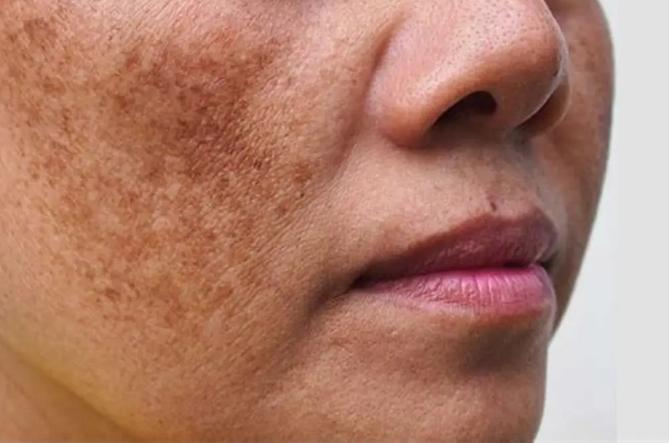 荷爾蒙斑去除方法