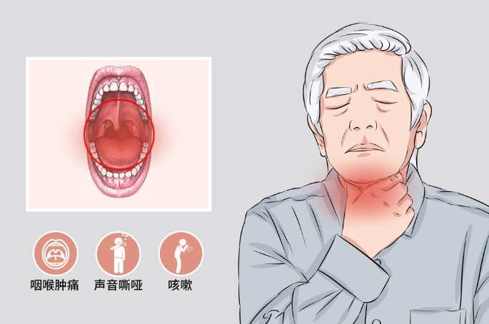 急性咽喉炎會自己好嗎