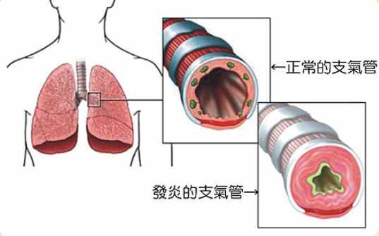 支氣管炎症狀