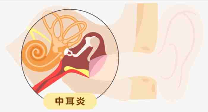 大人中耳炎會自己好嗎