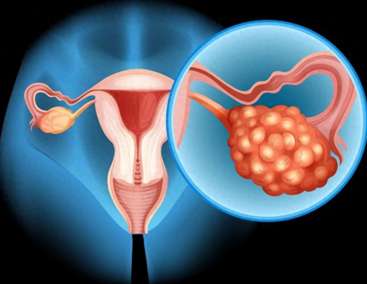 多囊性卵巢治療