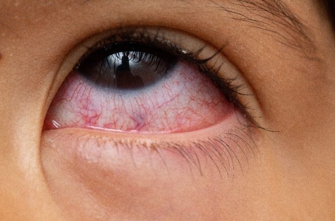 結膜炎多久會好