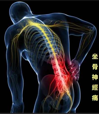 坐骨神經痛自癒