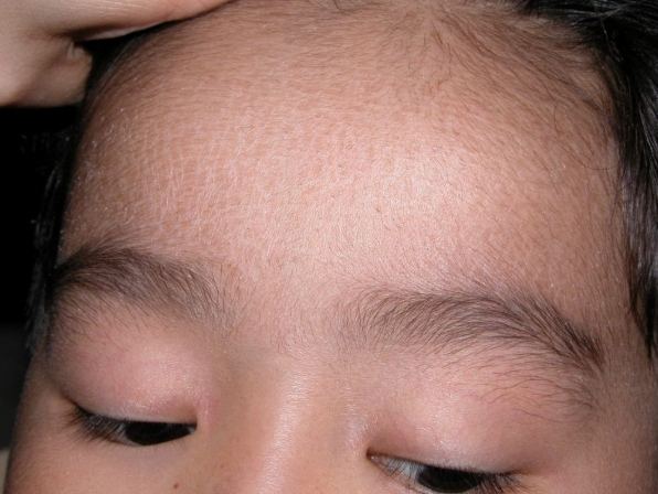 異位性皮膚炎可以吃橘子嗎