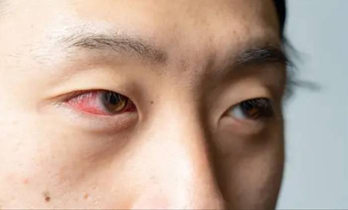 急性結膜炎多久會好