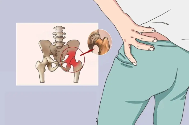 髖關節疼痛如何治療