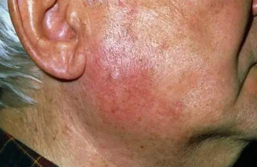 腮腺腫大乾燥症