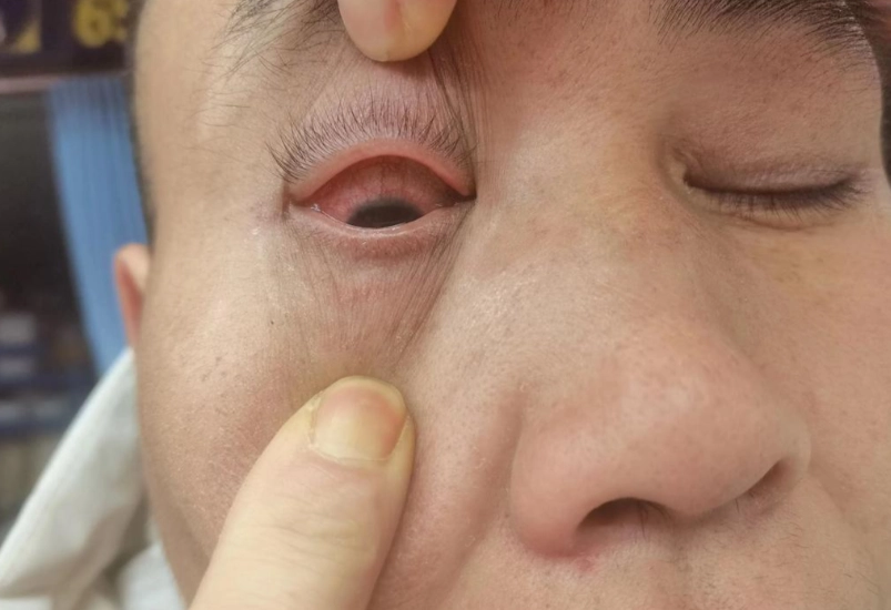 虹彩炎多久會好