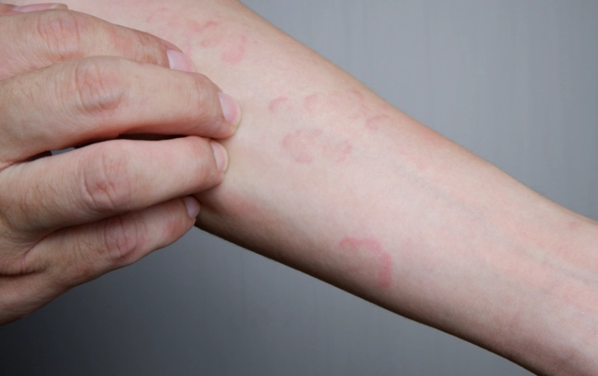 蕁麻疹多久會好