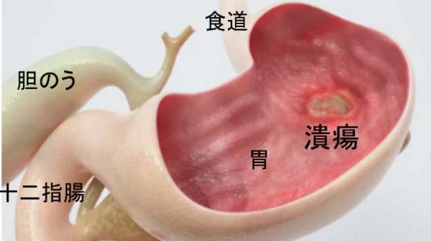 胃潰瘍多久會好