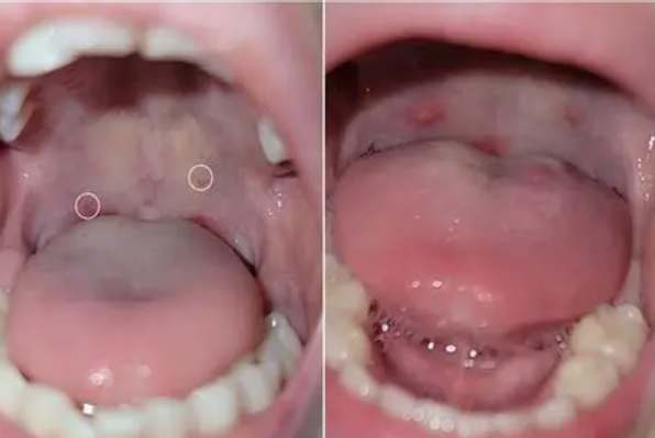 腸病毒喉嚨水泡