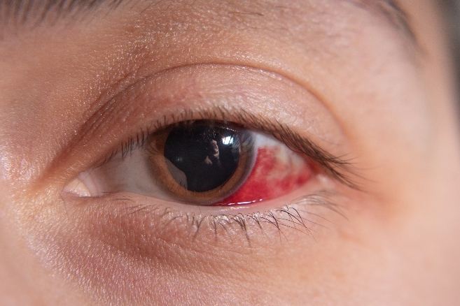 結膜下出血治療方法