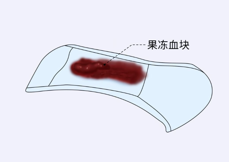月經血塊果凍