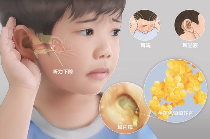 大人中耳炎初期症状