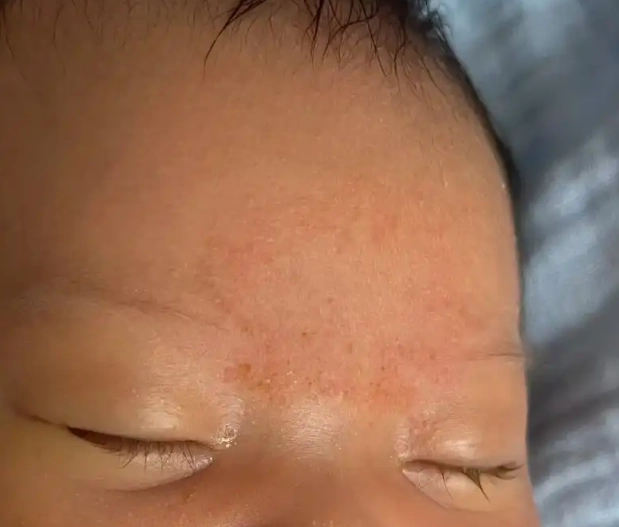 新生兒脂漏性皮膚炎多久會好