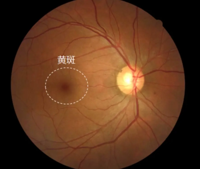 黃斑部病變治療