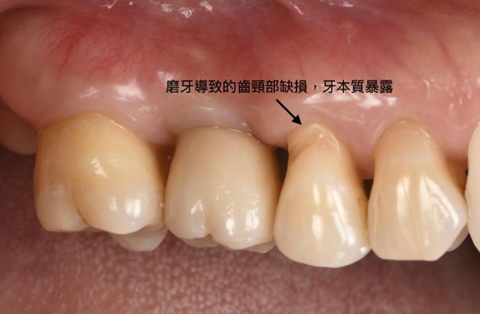 敏感性牙齒會好嗎