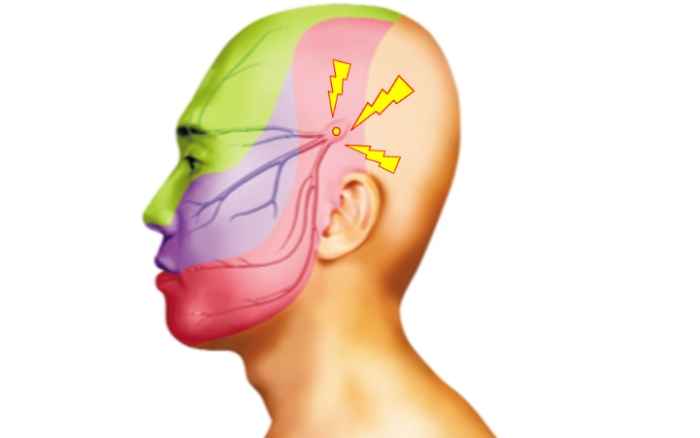 神經痛如何治療