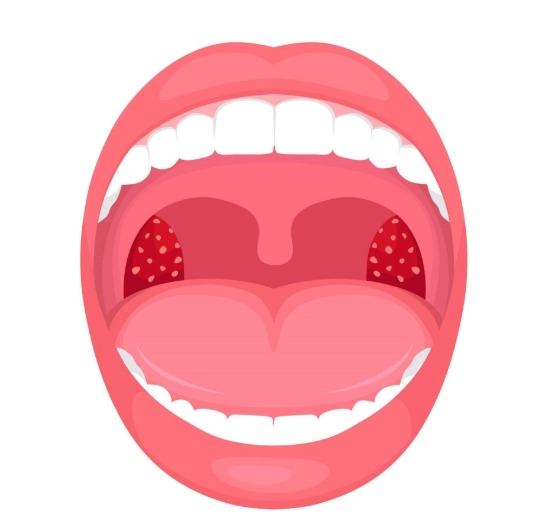 扁桃腺發炎多久會好