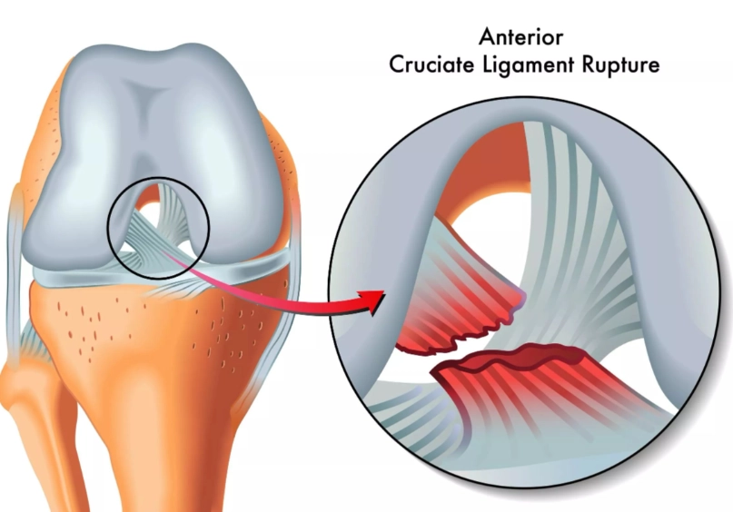 韌帶斷裂多久會好